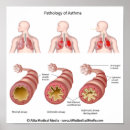 Zoek naar astma posters Allergie