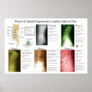 Zoek naar lumbaal posters Wervelkolom