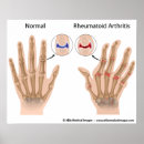Zoek naar reumatoïde artritis posters Gezondheid