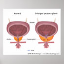 Zoek naar uroloog posters Blaas