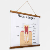 Abces in het tandvlees hangend wandkleed (Gebogen)