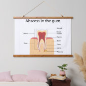 Abces in het tandvlees hangend wandkleed (Slaapkamer)