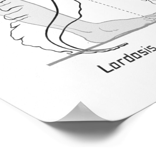 Abnormale Curves of the Spine Poster Chiropractic (Hoek)