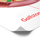 Acuut Pancreatitis Poster (Hoek)
