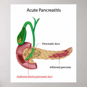 Acuut Pancreatitis Poster