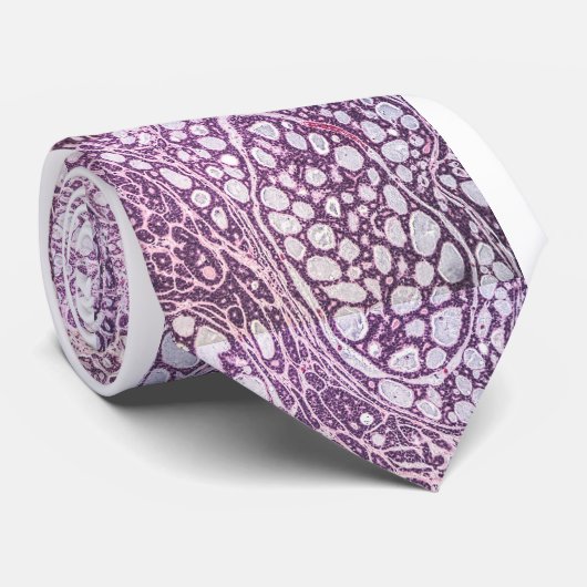 Adenoïd cystechnoomcarcinoom traanklier stropdas (Opgerold)