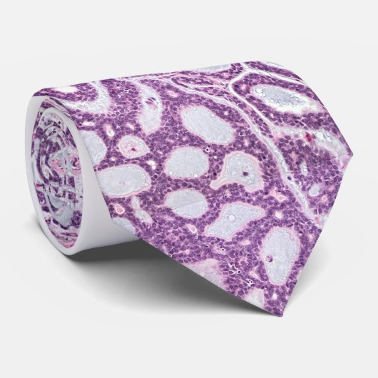 Adenoïd cystechnoomcarcinoom traanklier stropdas (Opgerold)