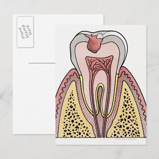 Afbeelding kruissectie met tandbederf briefkaart (Voorkant / Achterkant)