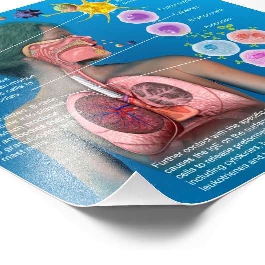 Allergieën: IgE ontstekingsreactie poster (Hoek)