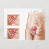 Anatomie van een blaasophanging briefkaart (Voorkant / Achterkant)