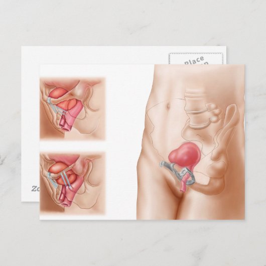 Anatomie van een blaasophanging briefkaart (Voorkant / Achterkant)