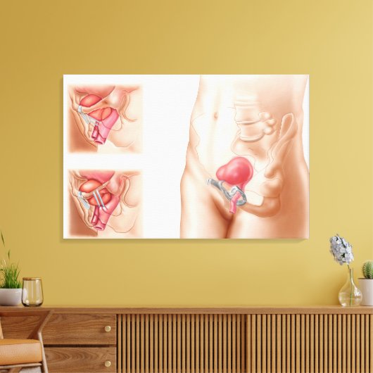 Anatomie van een blaasophanging canvas afdruk (Insitu (Woonkamer))