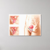 Anatomie van een blaasophanging canvas afdruk (Voorkant)