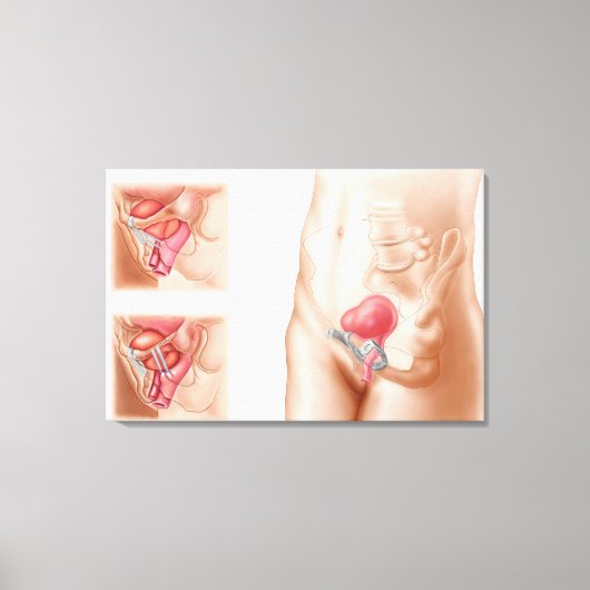 Anatomie van een blaasophanging canvas afdruk (Voorkant)