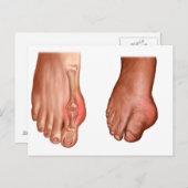 Anatomie van een gezwollen voet briefkaart (Voorkant / Achterkant)