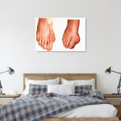 Anatomie van een gezwollen voet canvas afdruk (Insitu (Slaapkamer))