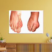 Anatomie van een gezwollen voet canvas afdruk (Insitu (Woonkamer))