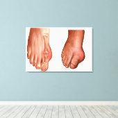 Anatomie van een gezwollen voet canvas afdruk (Insitu (Houten vloer))