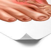 Anatomie van een gezwollen voet poster (Hoek)
