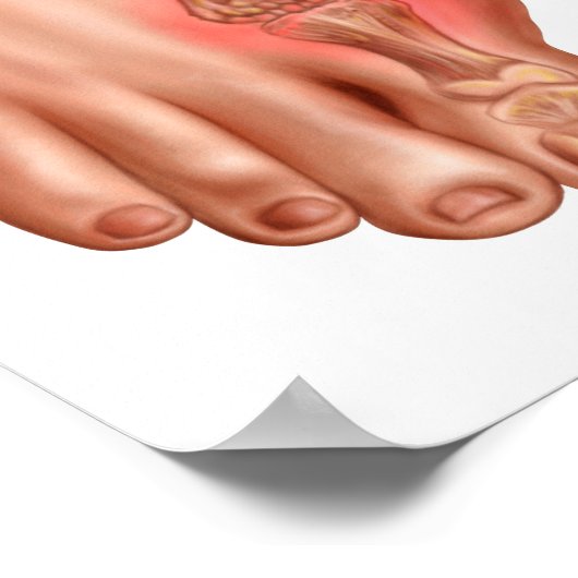 Anatomie van een gezwollen voet poster (Hoek)