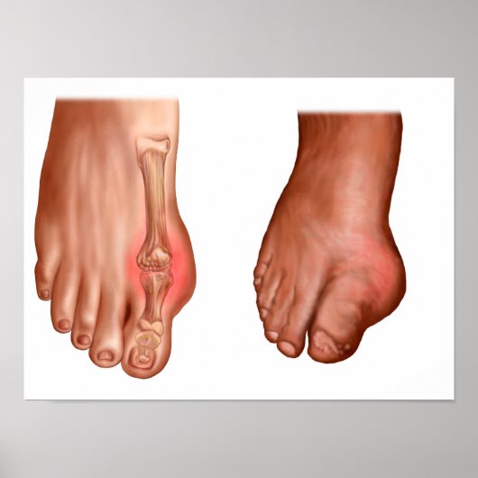Anatomie van een gezwollen voet poster (Voorkant)