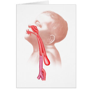 Anatomie van een tracheesophageale fistels