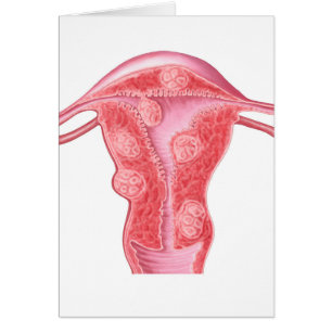 Anatomie van fibroïde tumoren in de baarmoeder van