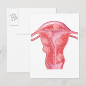 Anatomie van fibroïde tumoren in de baarmoeder van briefkaart (Voorkant / Achterkant)
