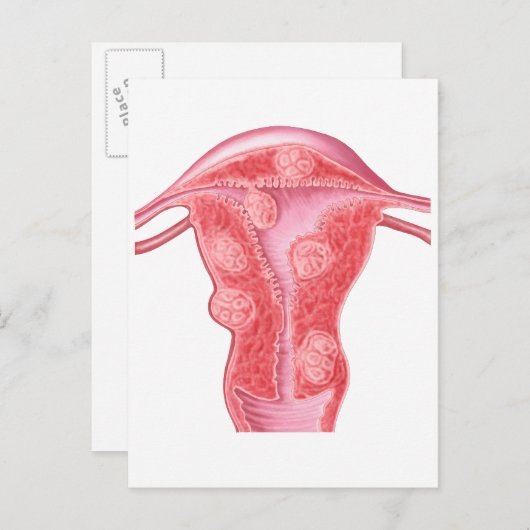 Anatomie van fibroïde tumoren in de baarmoeder van briefkaart (Voorkant / Achterkant)