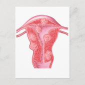 Anatomie van fibroïde tumoren in de baarmoeder van briefkaart (Voorkant)