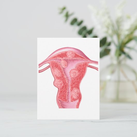 Anatomie van fibroïde tumoren in de baarmoeder van briefkaart (Staand voorkant)
