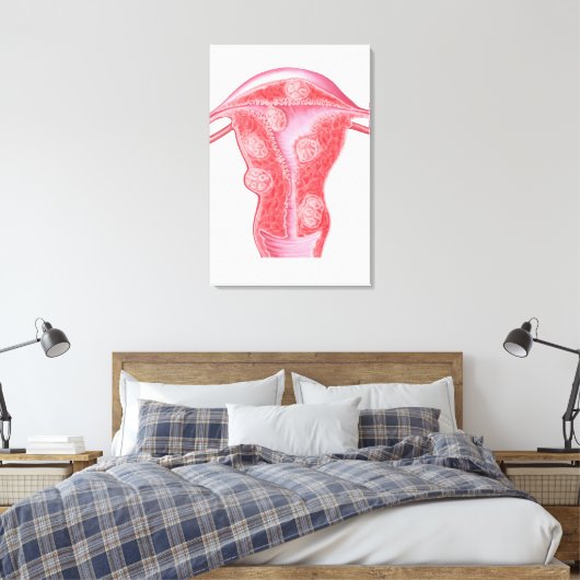 Anatomie van fibroïde tumoren in de baarmoeder van canvas afdruk (Insitu (Slaapkamer))