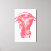 Anatomie van fibroïde tumoren in de baarmoeder van canvas afdruk (Voorkant)
