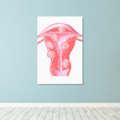 Anatomie van fibroïde tumoren in de baarmoeder van canvas afdruk (Insitu (Houten vloer))