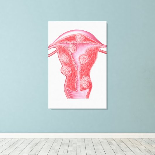 Anatomie van fibroïde tumoren in de baarmoeder van canvas afdruk (Insitu (Houten vloer))