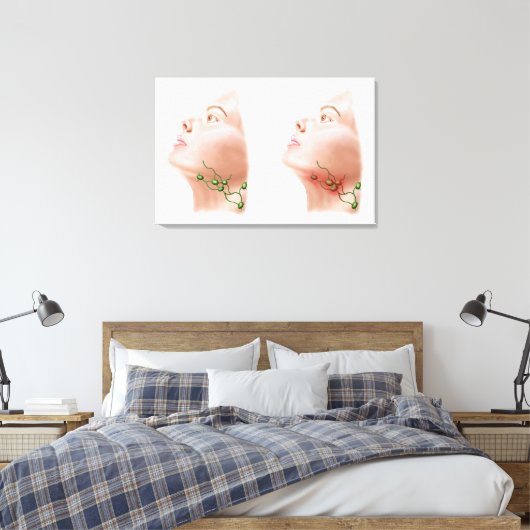 Anatomie van gezwollen lymfeknoden canvas afdruk (Insitu (Slaapkamer))