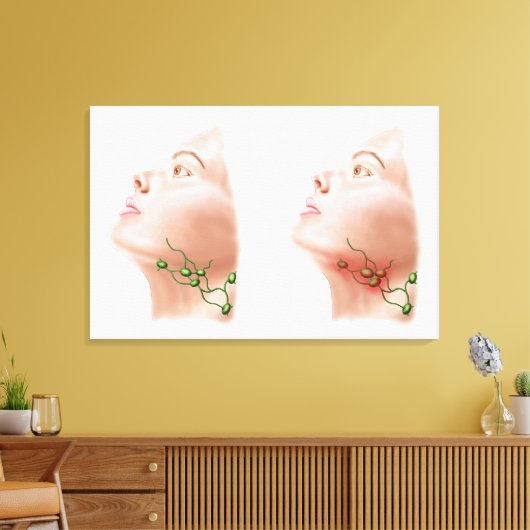 Anatomie van gezwollen lymfeknoden canvas afdruk (Insitu (Woonkamer))