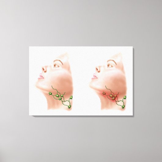 Anatomie van gezwollen lymfeknoden canvas afdruk (Voorkant)