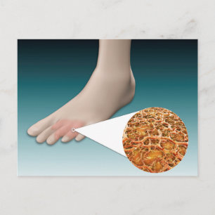 Anatomie van voetschimmel met microscopische close briefkaart