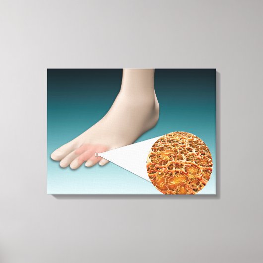 Anatomie van voetschimmel met microscopische close canvas afdruk (Voorkant)