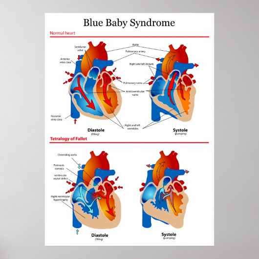 Anatomisch hartdiagram van blauw Baby syndroom Poster (Voorkant)