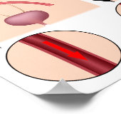 Aneurysme poster (Hoek)