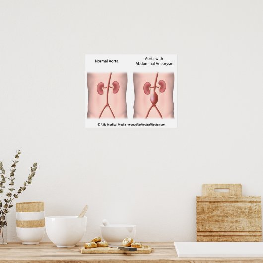 Aneurysme poster (Keuken)