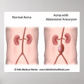 Aneurysme poster (Voorkant)