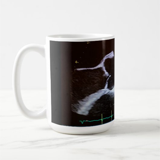 Aortaklep doppler echocardiogram cup koffiemok (Links)