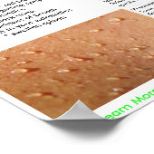 Babesia Symptomen en Poster van overdracht (Hoek)