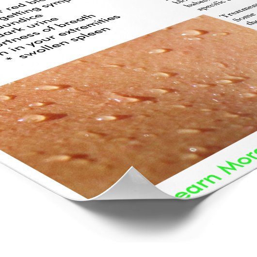 Babesia Symptomen en Poster van overdracht (Hoek)