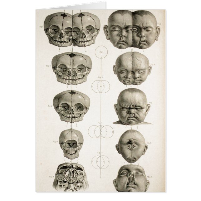 Baby schedeldefecten drager/samengevoegd Baby (Voorkant)