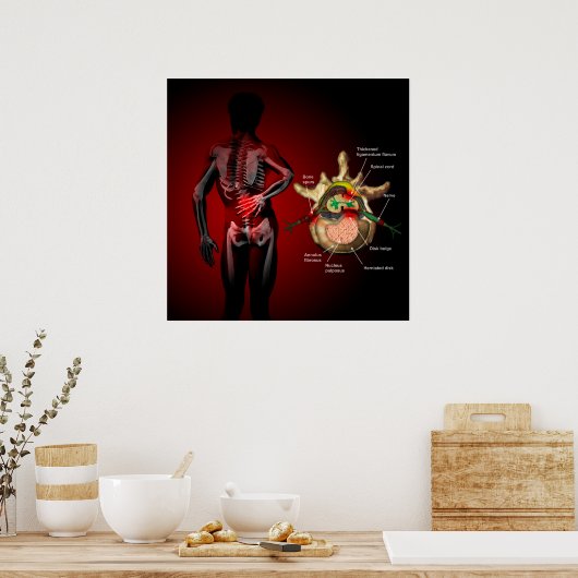Back pain poster (Keuken)