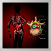 Back pain poster (Voorkant)